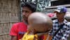 Tripura's 'giant head’ baby girl dies before corrective surgery