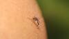 Australian man dies after catching Japanese encephalitis in Thailand – How to recognise JE symptoms