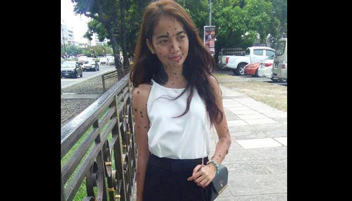 Year Old Malaysian Girl With Multiple Moles Auditions For Miss Universe Health News Zee News