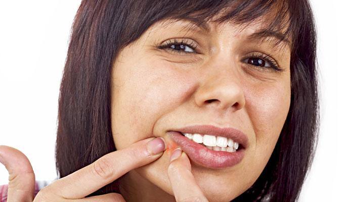 Here's how you can enjoy an acne-free monsoon