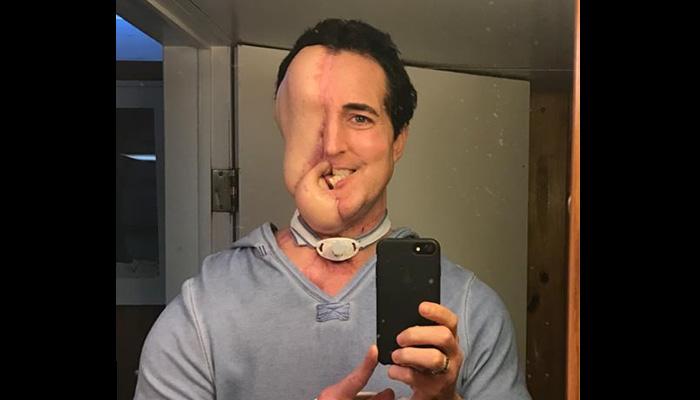 Tumour has left this 38-year-old man half-faced! Tumour has left this 38-year-old man half-faced!