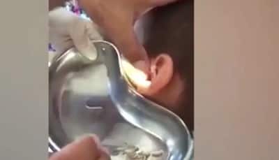 Doctor removes dozens of squirming live maggots from boy's ear – Watch the video!