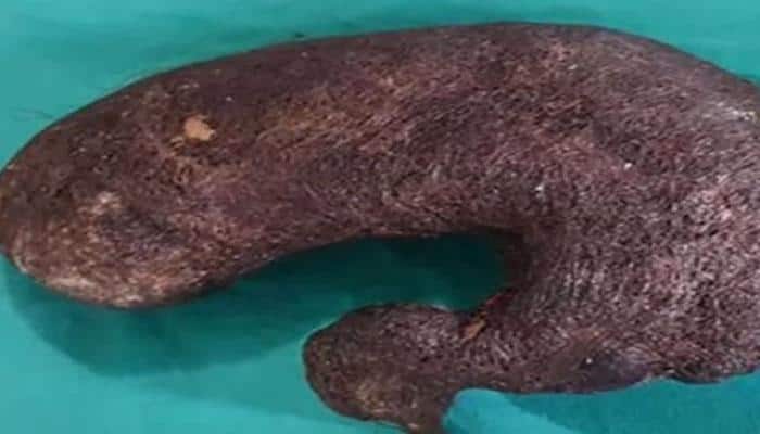 Doctors remove massive lump of hair from 16-year-old girl's stomach in  Dehradun – Watch the video | Health News | Zee News