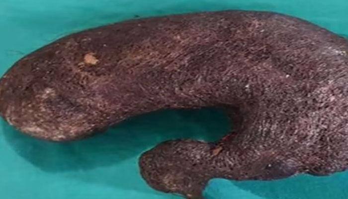 Doctors remove massive lump of hair from 16-year-old girl's stomach in Dehradun – Watch the video
