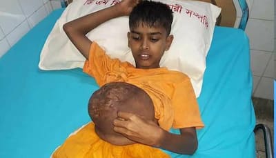 Meet this 13-year-old Bangladeshi boy, who has football-sized hernia bursting out from stomach!