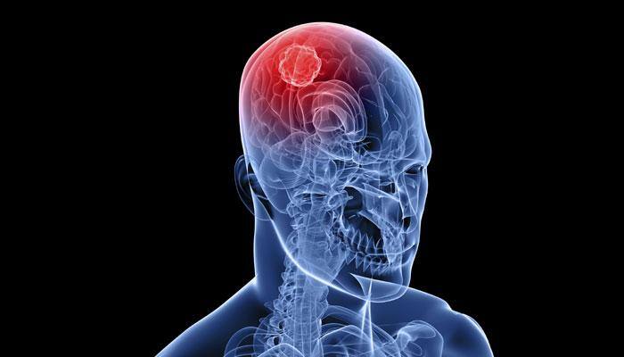 Doctors remove 98 cancerous tumours from 46-year-old man's brain