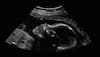 Doctors in India witness a rare case of 'fetus-in-fetu' after baby is born 'pregnant' with twin brother!