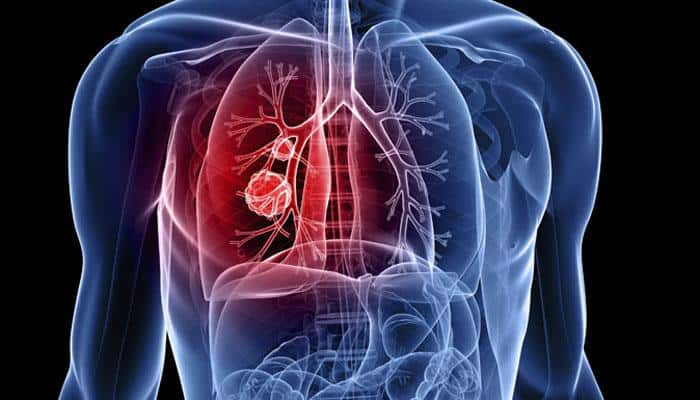 Gold nanoparticles maybe useful in treating lung cancer: Study