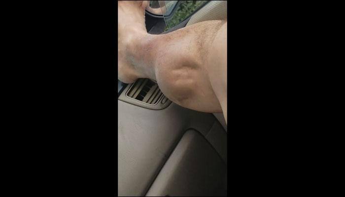 Mind blown! Agonising muscle cramp makes man's calf wriggle like a foetus in a mother's womb – Watch video
