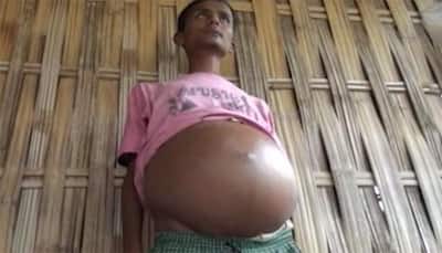 Survival is a distant dream for Assam man who has to go through life with 59-inch stomach
