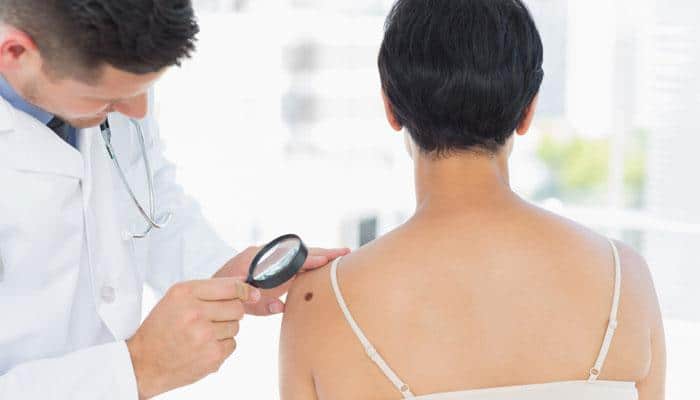 Artificial Intelligence system may help detect melanoma skin cancer 