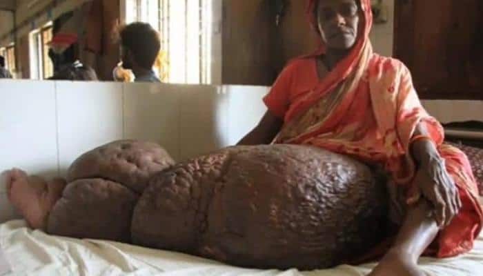 40-year-old Bangladeshi woman has a leg that weighs 60 kg – Find out why!