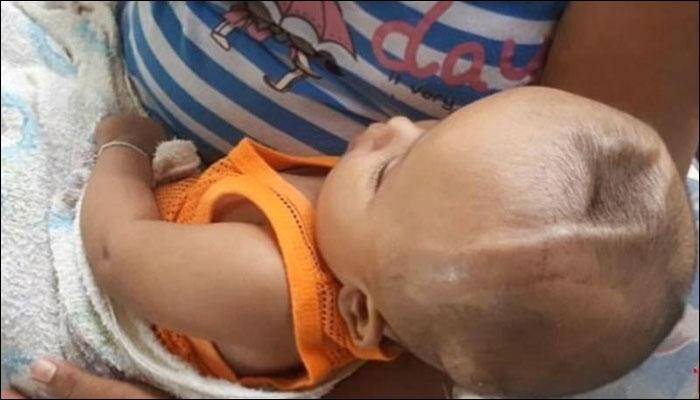 Baby with 2-inch cavity on head abandoned by parents – Read his heart-breaking ordeal