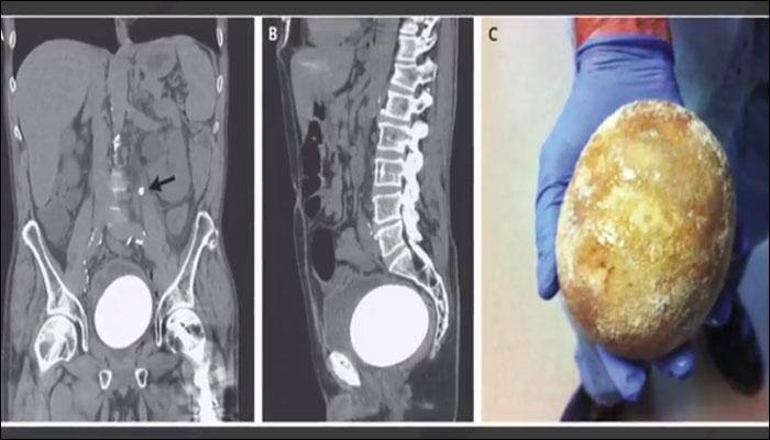 Stone the size of an ostrich egg removed from man's bladder!