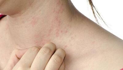 Hard water can damage skin, cause eczema: Study