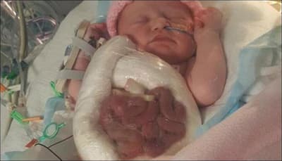 Mother shares image of her daughter born with intestines outside her body
