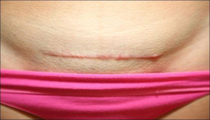 Study links length of incision to pain after caesarean