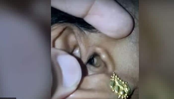 Shocking! Hairy spider finds home in this Karnataka woman&#039;s ear: Watch