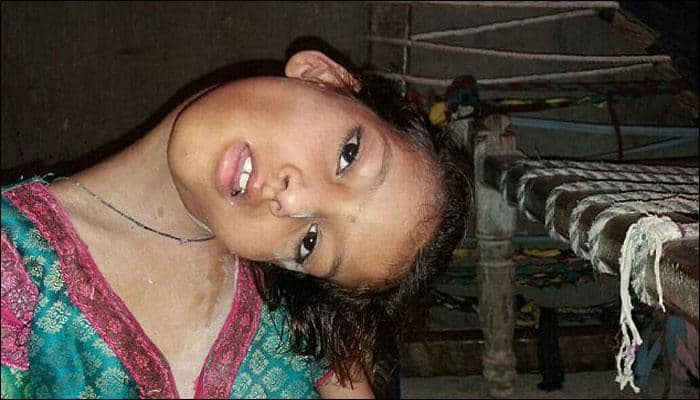 9-year-old Pakistani girl with hanging head lives as an outcast – Here&#039;s her story