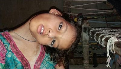 9-year-old Pakistani girl with hanging head lives as an outcast – Here's her story