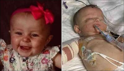 10-month-old at danger of losing all her limbs in worst case of meningitis in 25 years