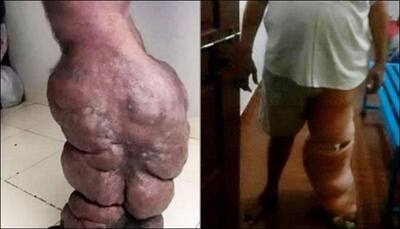 Mosquito bite causes man's leg to swell up to four times the normal size