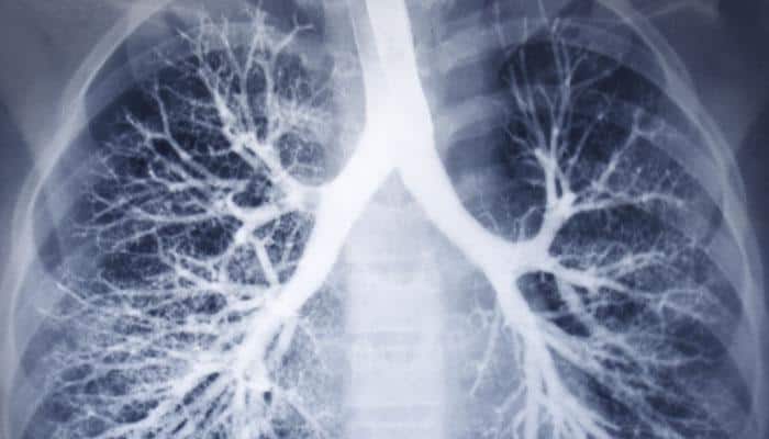 Indians&#039; lung capacity 30% lower than North Americans, Europeans: Scientist 