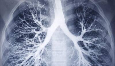 Indians' lung capacity 30% lower than North Americans, Europeans: Scientist 