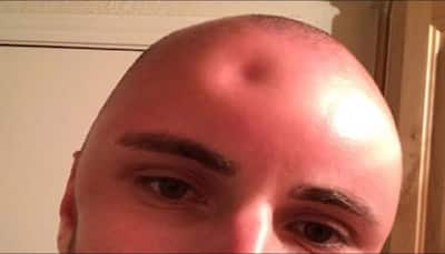 Texas man left with golf ball-sized dent in forehead as a result of sunburn - See pics