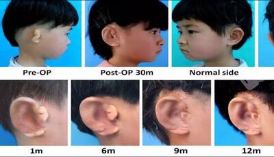 Breakthrough! Five children receive new ears grown from their own cells