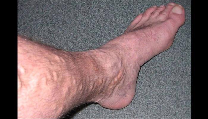 Varicose viens may increase risk of blood clots