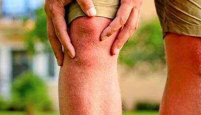 Lap-band surgery may lower chronic knee pain