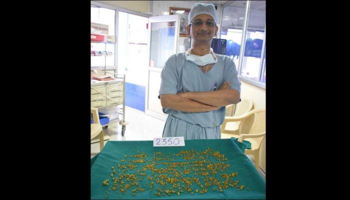 Mumbai doctors remove 2,350 stones from 50-year-old woman's gallbladder