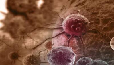 New biomarker helps identify cancer chemotherapy timing