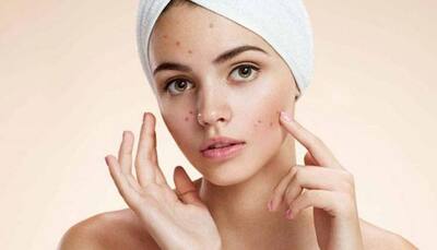 Acne woes? Follow these simple tips to keep pimples at bay