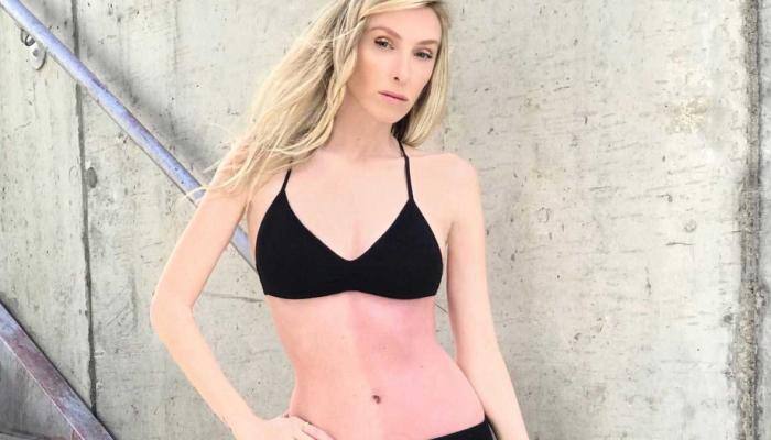 Despite rare genetic condition, California woman becomes model