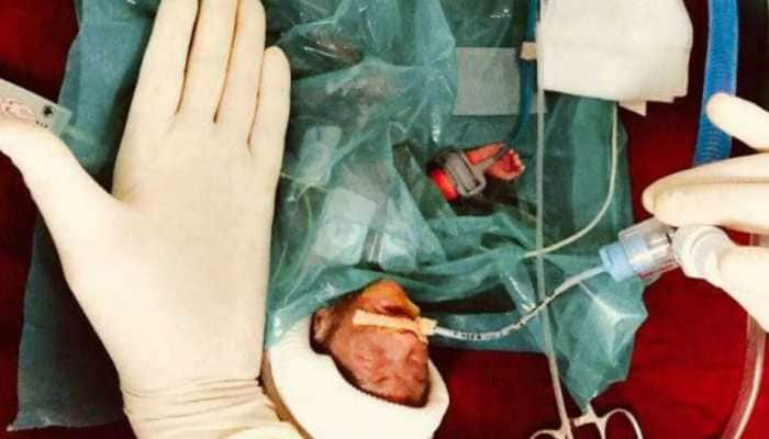 Size of a palm: Weighing 375 grams, India&#039;s smallest baby is born