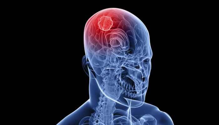 Brain tumors may occur in children with the common genetic syndrome