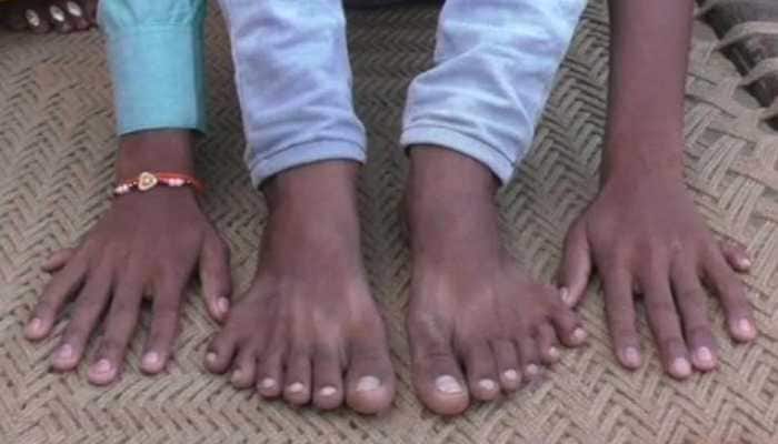 UP boy with 12 fingers, 12 toes faces threat to life, claims family