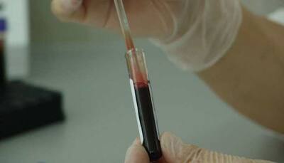New blood test to screen for secondary heart attack: Scientists 