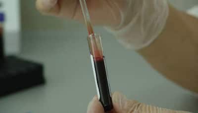 New blood test to screen for secondary heart attack: Scientists 