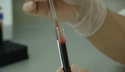 Lakhimpur Kheri: Health departmentt on alert after man tests positive for swine flu
