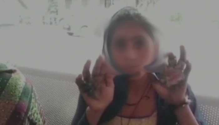 In-laws burn woman's hand after accusing of adultery