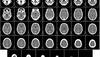 AI system learns to diagnose, classify intracranial haemorrhage