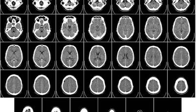 AI system learns to diagnose, classify intracranial haemorrhage