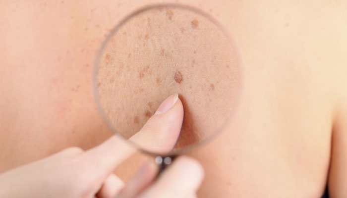 Cancer patients face higher risk of painful skin condition