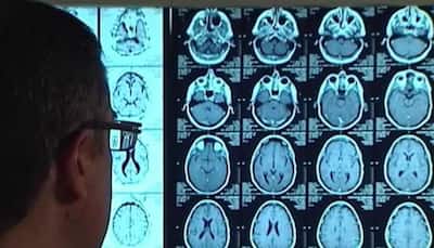 Study finds stroke drug could prevent Alzheimer's disease