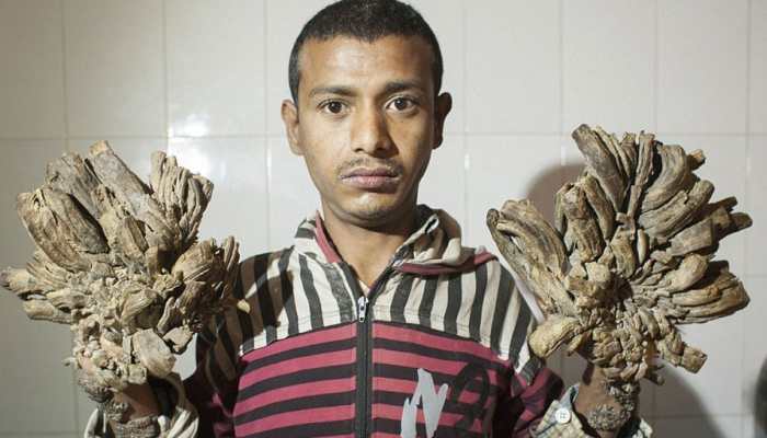 Bangladesh's 'tree man' Abul Bajandar back in hospital for more surgeries