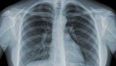 AI-based system to cut process time for abnormal chest X-rays