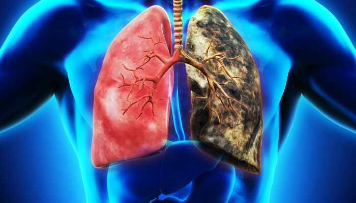 Graphene biosensor could diagnose lung cancer early